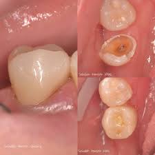 How long will it take to recover? Confident Bali Dental Clinic Best Dentist In Bali