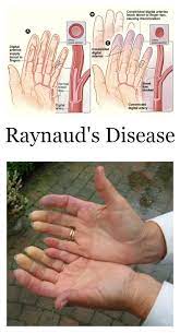 Raynauds Disease Syndrome The Term Syndrome Is Used To Describe The Symptoms Of Raynauds Disease When They Occur In Conjunc Raynaud S Disease Raynauds Disease