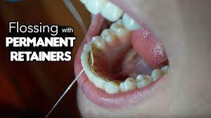 How long after braces do you need to wear your retainer? Flossing Tricks For Permanent Retainers