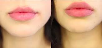 I Tried Pmd Beauty S Insane Lip Plumping System Cafemom Com