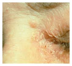 Figure 1 Ileocecal Adenocarcinoma And Ureteral Transitional Cell Carcinoma With Multiple Sebaceous Tumors And Keratoacanthomas In A Case Of Muir Torre Syndrome