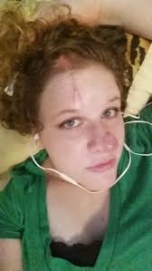 Lumps or bumps under the skin the lymphoma might affect only a small area of skin, or it might affect large areas of the body. Skin Cancer Scare She Thought The Red Spot Was A Pimple