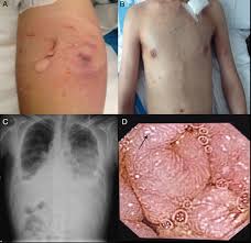 Image result for Intestinal Enteropathy