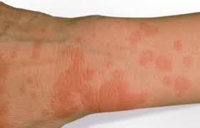 Sonnenallergie Pld Eucerin