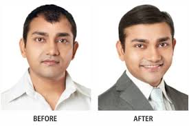 Anagrow hair treatment review by ekta thakur. Best Hair Thinning Treatment Richfeel Anagrow 100 Effective
