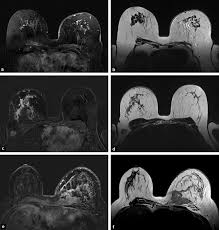 Image result for Inflammatory breast cancer