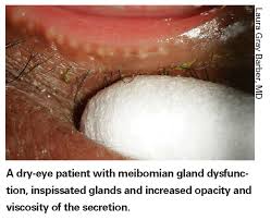 Beyond The Standard Dry Eye Diagnostic Tools