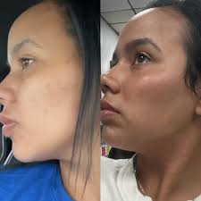 The before and after everyone needs to see as we enter back into peel  season soon 🖤🤎🤍 This patient wanted to get rid of her hyperpigmentation  and scarring left behind from acne.