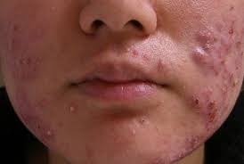 Ok, kalau sudah tersedia silahkan parut wortelnya hingga menjadi halus lalu applikasikan wortel yang sudah diparut tesebut sebagai masker kemudian tempelkan di wajah anda selama 20 menit. 9 Cara Menghilangkan Jerawat Nodul Pada Wajah Secara Alami Dan Sehat Atmago