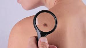 Birthmarks can be a significant source of embarrassment for adults and children alike. Doctors Reveal The Real Meaning Of Your Birthmark Shape Aboutcancerservice