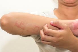 Image result for scabies effects on the human body