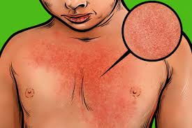 Repeat cases of roseola can happen, but are uncommon. How To Identify Common Childhood Rashes The New York Times
