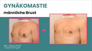 Gynakomastie Korrektur Der Mannerbrust Dr Edvin Turkof Wien