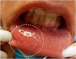 Image result for syphilis ulcer