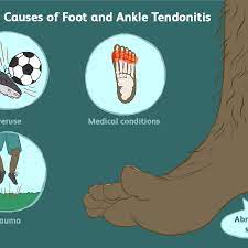 Flexor tendon zones influence prognosis following flexor tendon repair. Treatment For Tendonitis Of The Foot And Ankle