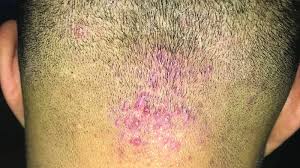 Image result for folliculitis symptoms