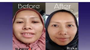 Cream Penghilang Flek Hitam Usia 40 Wa 0895320904610 Jerawat Flek Hitam Anti Penuaan