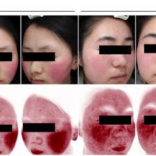 VISIA® Skin Analysis System shows the comparison of the white light...