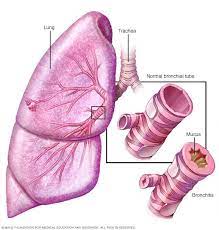 Illustration Of Bronchitis Enfermedad Pulmonar Obstructiva Cronica Epoc Causas