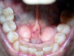 Que Son Los Torus Dentales Y Como Se Pueden Tratar Bqdc