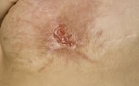 Learn about the symptoms, diagnosis, treatment, and prevention of mrsa infections. How Mrsa Mersa Is Diagnosed