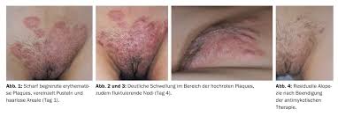 Image result for penis mycosis symptoms