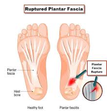 Dec 28, 2018 · i usually judge feet from two perspectives: Plantar Fasciitis Or Plantar Fascia Tear