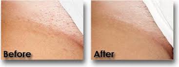 Check spelling or type a new query. Before After Laser Hair Removal Photos Laser Affair