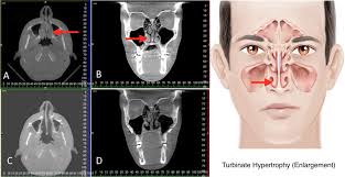 Nasal polyps (np) are noncancerous growths within the nose or sinuses. Ent Sinus Children Otolaryngology Specialists Of North Texas