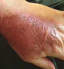 Image result for Skin Trauma