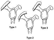 These pictures of this page are about:acromion types mri Painful Shoulder Impingement Syndrome Hc Chang Orthopaedic Surgery Singapore