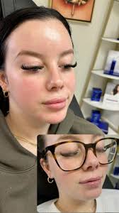 Healed lips + fresh chin 🤌🏼, #lipfiller #chinfiller #restylane  #restylanelyft #rha #rhafiller #nurseinjector #beforeandafter #diva  #murrayky #murraystate #westernky