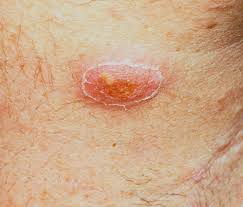 At the same time, sanitizer levels that are too high increase your risk for chlorine pool rash or bromine rash. Folliculitis Acute Bacterial Bockhart S Impetigo Superficial Pyoderma Hot Tub Folliculitis Sycosis Vulgaris Barbae Or Barbers Itch Furuncles Boils Carbuncles Dermatology Advisor