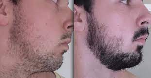 Except, that there is one, and that's minoxidil also known by the brand name rogaine (regaine in the uk) and many of its generic variants like kirkland, equate, tugain, etc. Good Or Bad Does Rogaine Really Help Grow A Beard
