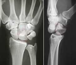 Image result for Wrist XRay