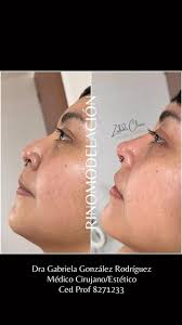 ▫️▫️▫️▫️▫️RINOMODELACIÓN ▫️▫️▫️▫️▫️, CON RELLENO DE ÁCIDO HIALURÓNICO, El  ácido hialurónico 💦 es un relleno seguro, biocompatible y reabsorbible.,  Cómo primer paso realizamos la valoración 🔍👩‍⚕️👨‍⚕️ ...