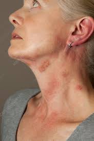 Woman with Poison Ivy