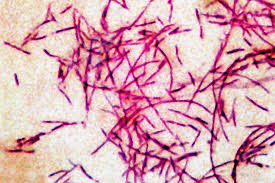 Jul 02, 2009 · le pneumocoque est l'agent infectieux le plus fréquent et fait parti des deux germes les plus graves avec legionnella pneumophila (responsable de légionellose). Legionellose Der Erreger Der Aus Der Warme Kam