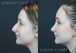 This wonderful patient was bothered by her nasal bump and also felt her tip  was droopy. She wanted her nose to be in greater harmony with her face.