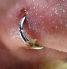 Infected Nose Piercing Causes Nose Piercing Bump Nose Piercing Piercing Bump