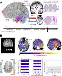 Non-invasive Temporal Interference Stimulation of the Hippocampus  Suppresses Epileptic Biomarkers in Patients with Epilepsy: Biophysical  Differences between Kilohertz and Amplitude Modulated Stimulation