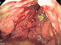 If you have symptoms that might be from stomach cancer, your doctor will ask you questions about them and do a what will the surgery be like? Linitis Plastica Wikipedia