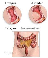 Rak Kishechnika Stadii Simptomy Techenie Zabolevaniya Osobennosti Lecheniya Opuholi Prognozy I Rekomendacii