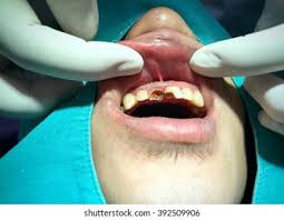 Image result for Pulpitis