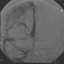 Jetzt macht das krankheitsbild schlagzeilen, da es bei personen im nachgang einer. Mri Library Sinusvenenthrombose