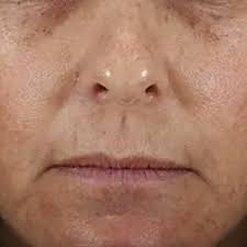 Image result for Melasma