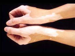 Is Eating Fish And Drinking Milk After That Causes White Patches On Skin Madspread