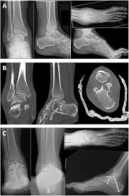 The combined talus and sustentaculum fracture: A case series