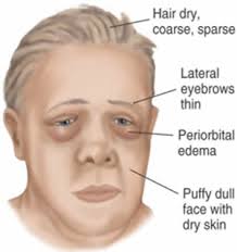 Hirsutism is stiff or dark body hair, appearing on the body where women don't commonly have hair — primarily the face, chest, lower abdomen, inner thighs and back. Light Therapy And Hypothyroidism Red Light Man