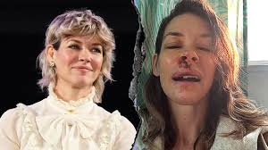 Evangeline Lilly shares photos of injuries after beach blackout incident